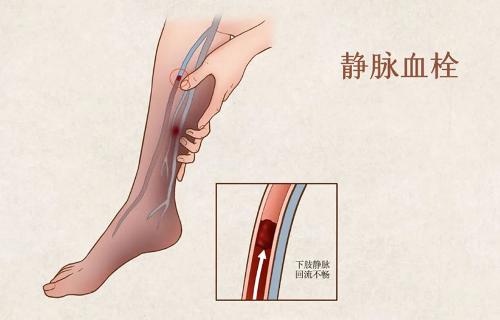关于深静脉血栓，这些知识你要知道