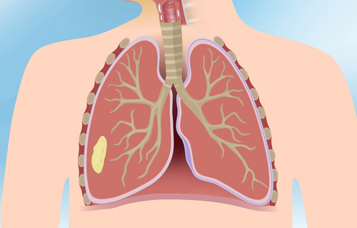 肺结核痊愈停药后的注意事项
