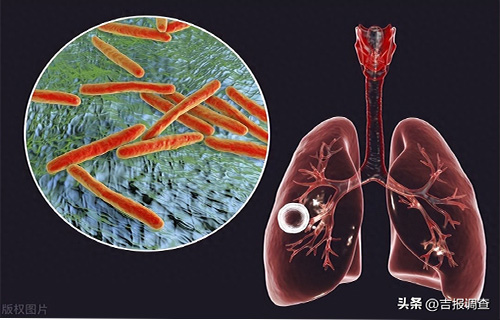 求证 ： 骨头怎么“惹”着结核了