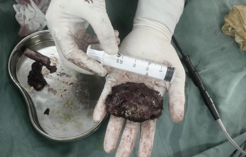 案例丨出血量仅100ml！91做爱
微创手术再升级